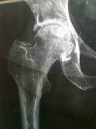 Artrosi dell'anca radiografia
